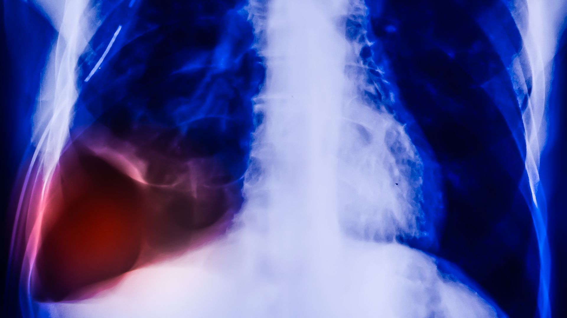 Odma płucna widoczna na obrazie z prześwietlenia klatki piersiowej pacjenta.