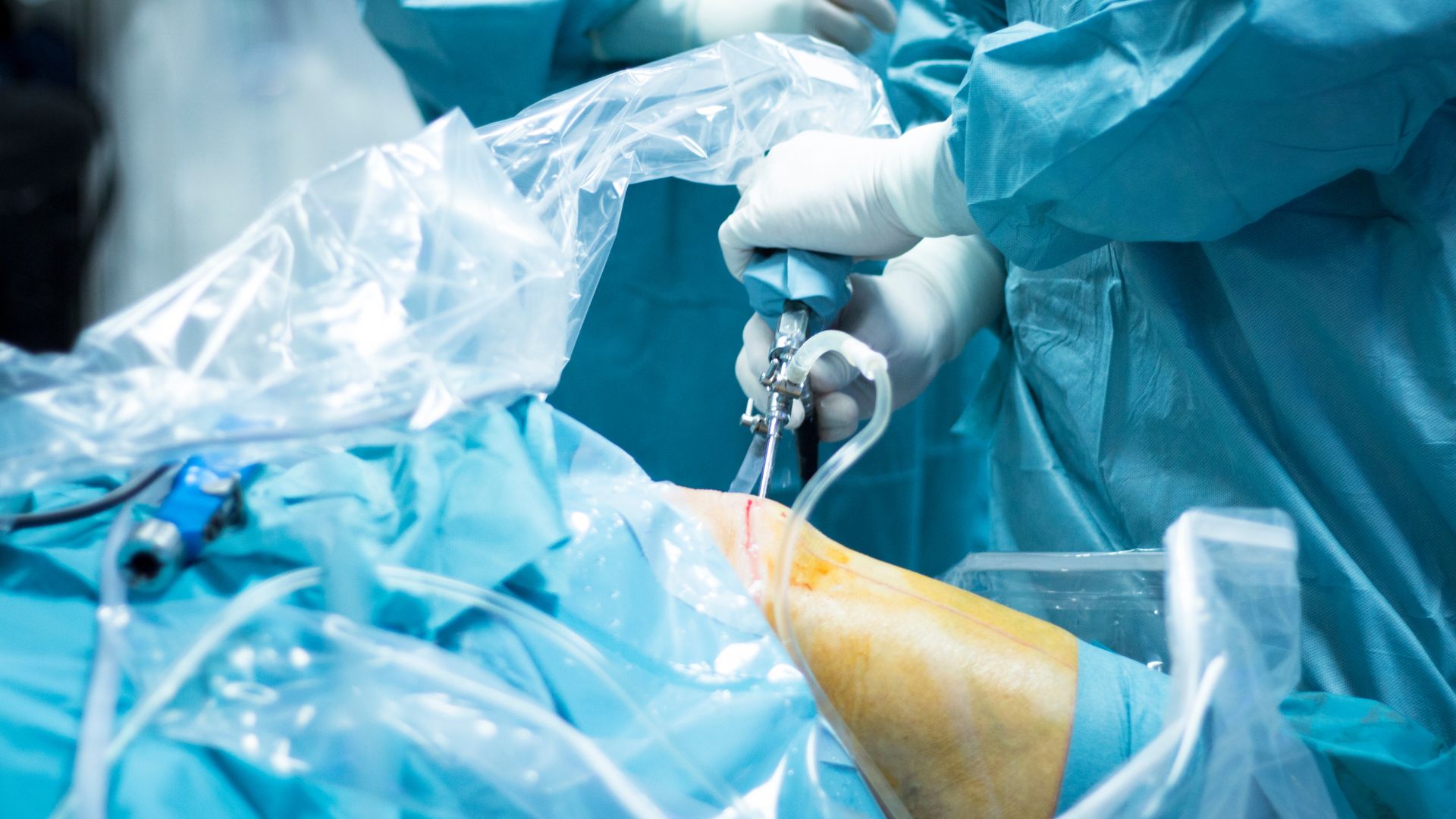 Operacja kolana przeprowadzana u pacjenta na stole operacyjnym. Chirurg korzysta z urządzenia do artroskopii.
