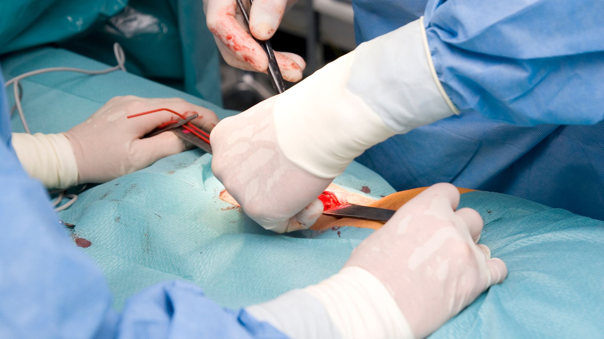 Operacja przepukliny wykonywana przez zespół chirurgów na sali .