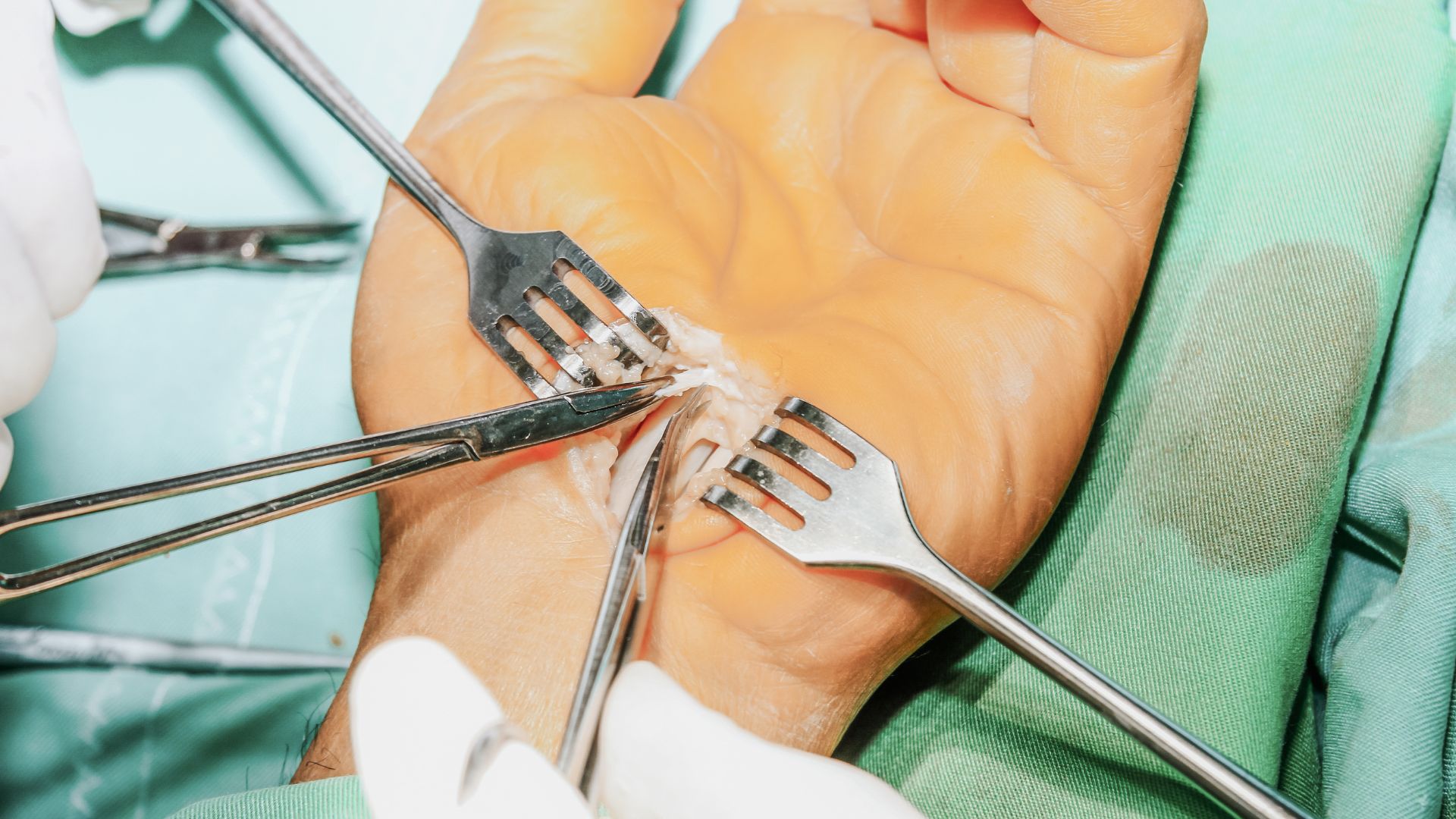 Tak operowany jest zespół cieśni nadgarstka. Chirurdzy wykonali nacięcie od wewnętrznej strony dłoni i rozpoczynają eliminowanie dolegliwości.